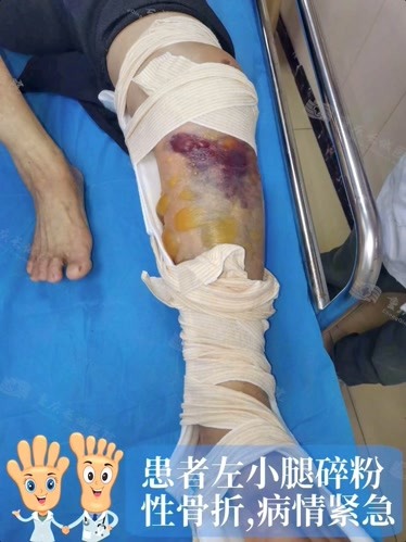 骨折,長城醫院醫生主動為患者獻血共1000ml-健康-完整版視頻在線觀看