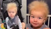 太罕见！男婴患上“难梳头发综合征”，拥有一头爱因斯坦同款发型