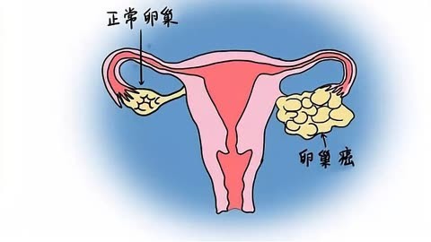 卵巢癌症状大揭秘!你知道最常见的5个转移部位吗?